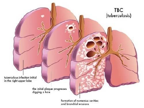 Tuberculosis (TB) & Post-COVID Lung Care